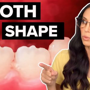 What Does This Tooth Shape Mean!? (Mamelons Explained)