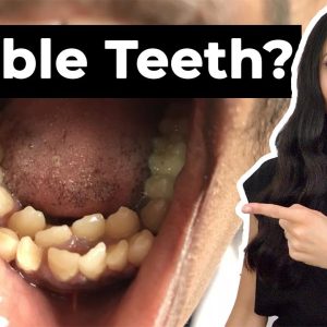 Why 3.8% of People Have Extra Teeth