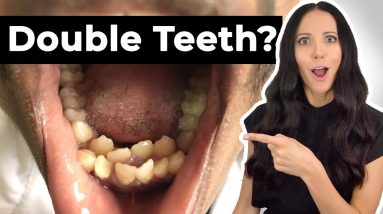 Why 3.8% of People Have Extra Teeth