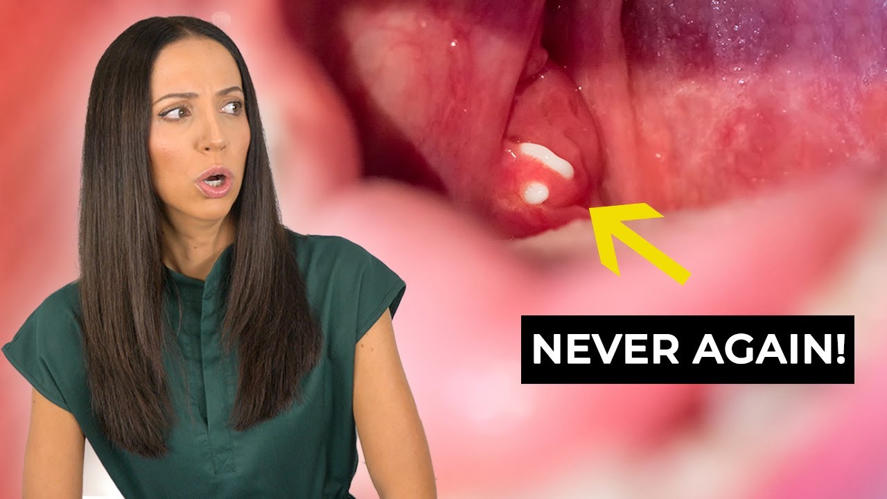 How to prevent tonsil stones etoners