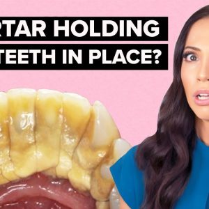 Is Tartar HOLDING Your Teeth In Place? (Calculus Bridge Explained)