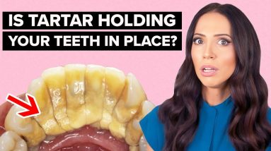 Is Tartar HOLDING Your Teeth In Place? (Calculus Bridge Explained)