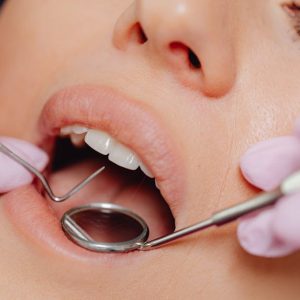 close up photo of a woman getting a dental check up