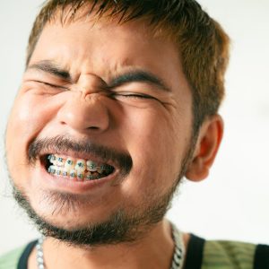 man with braces on teeth